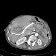 Parenchymal bleeding in liver after PTC (percutaneous transhepatic cholangiography) - after: CT - Computed tomography